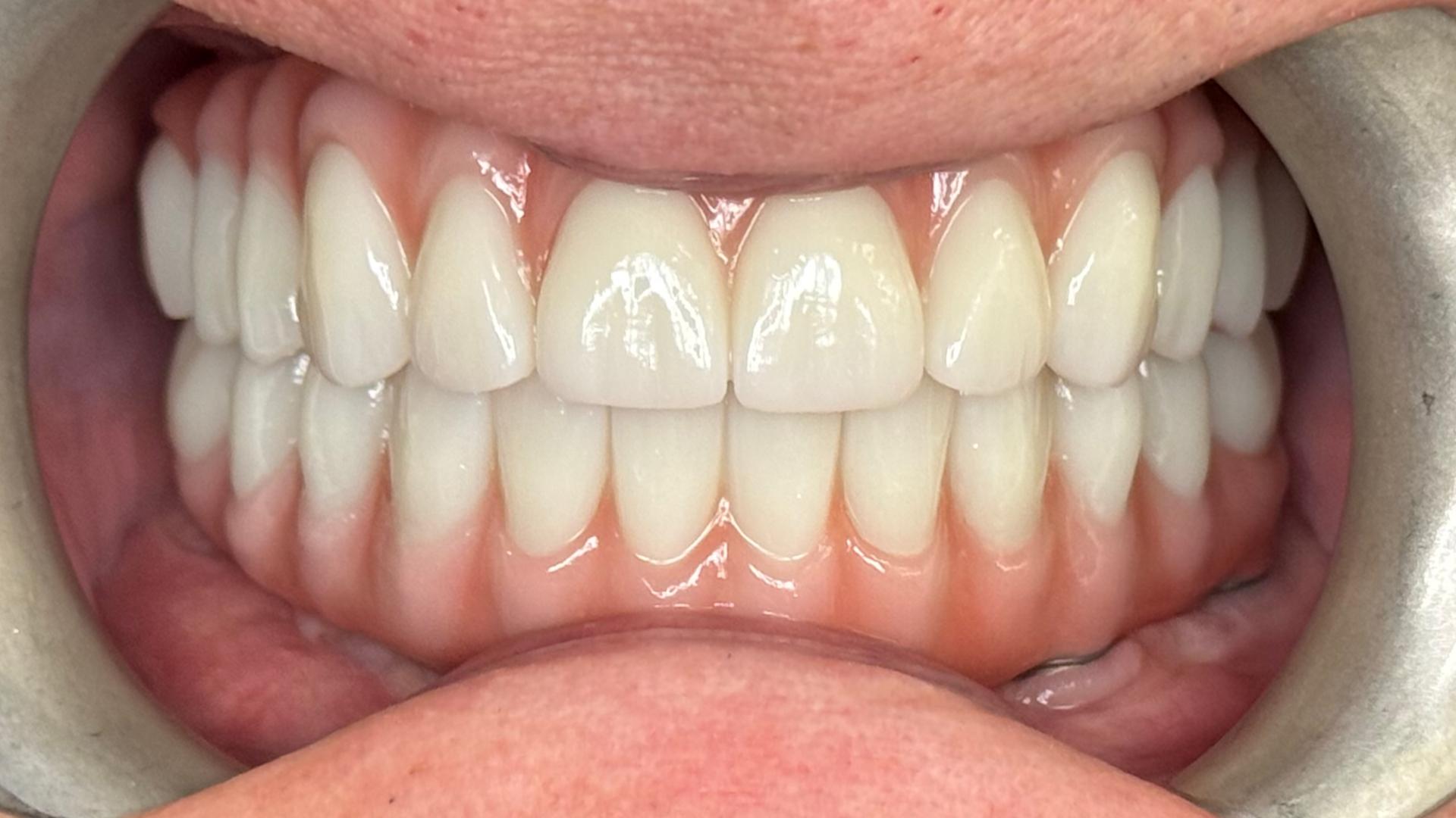 Patient after dental transformation showing beautiful smile